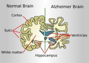 Alzheimer_wikimedia_commons_2017