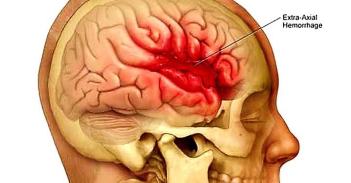 Emorragia cerebrale di Daniele Scardina, cos’è