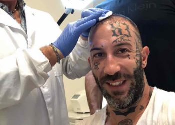 Simone Coccia, trapianto capelli