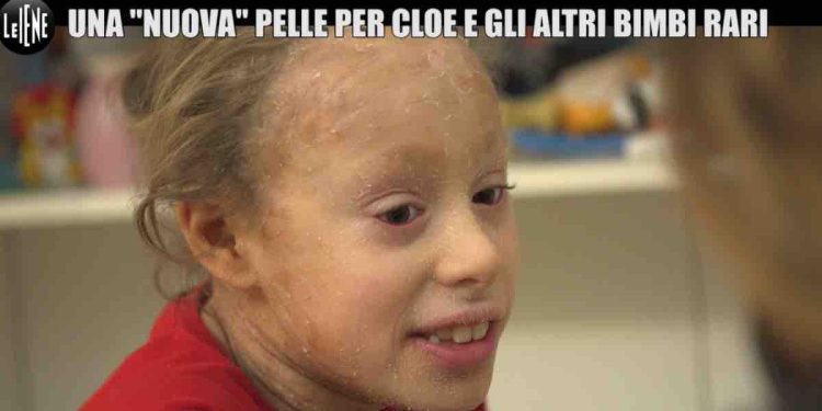 Le Iene, ittiosi la malattia della pelle