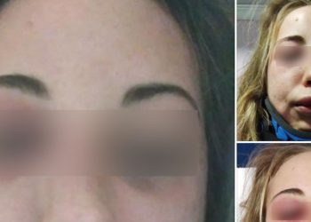 Caterina Degli Esposti, pubblica foto violenze subite su Facebook