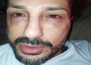 Fabrizio Corona problema agli occhi