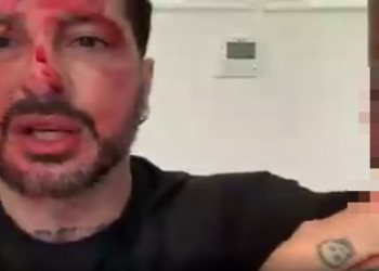 Fabrizio Corona si ferisce al braccio (Foto: Non è l'Arena)