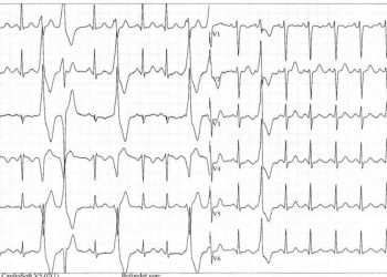 Elettrocardiogramma che mostra aritmie cardiache
