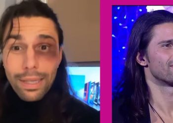 Luca Onestini rimedia un occhio nero per il match PSG_Real Madrid (foto:nweb)