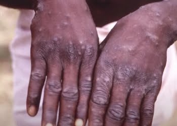 Jynneos, vaccino contro vaiolo delle scimmie