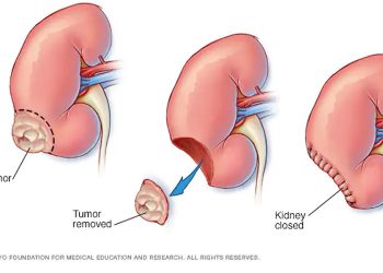 Nefrectomia parziale