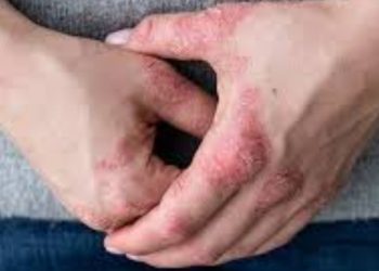 Mani con psoriasi (Fonte: web)