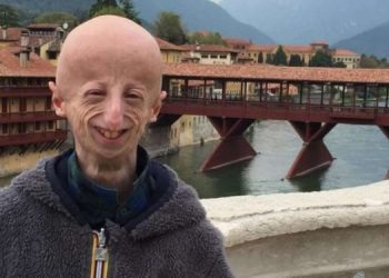 Sammy Basso, cos'è la Progeria