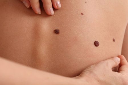 Automonitoraggio dei nei