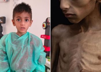Osama al-Raqab, il bimbo di Gaza che muore di fame