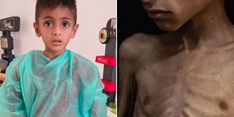 Osama al-Raqab, il bimbo di Gaza che muore di fame