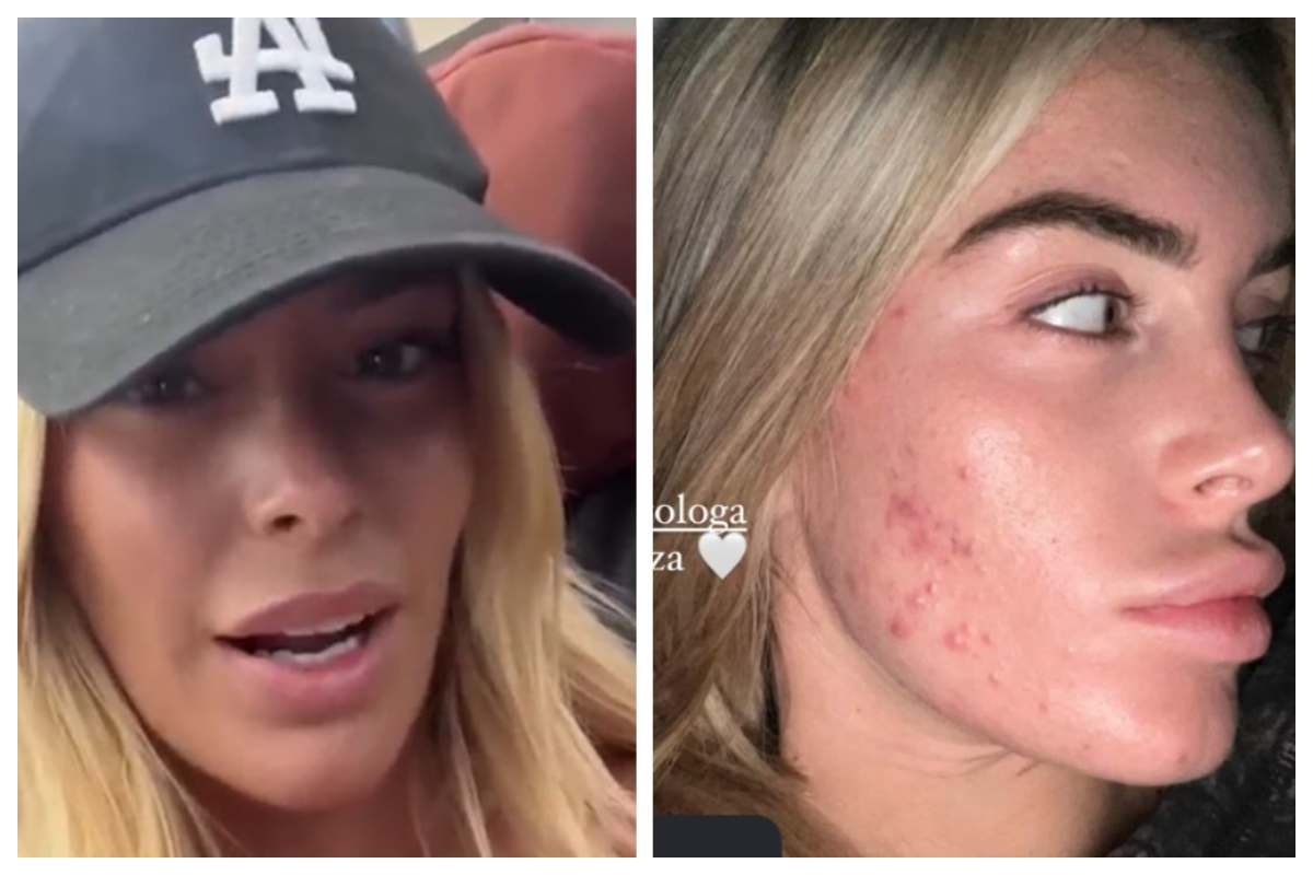 codegoni parla del trattamento labbra