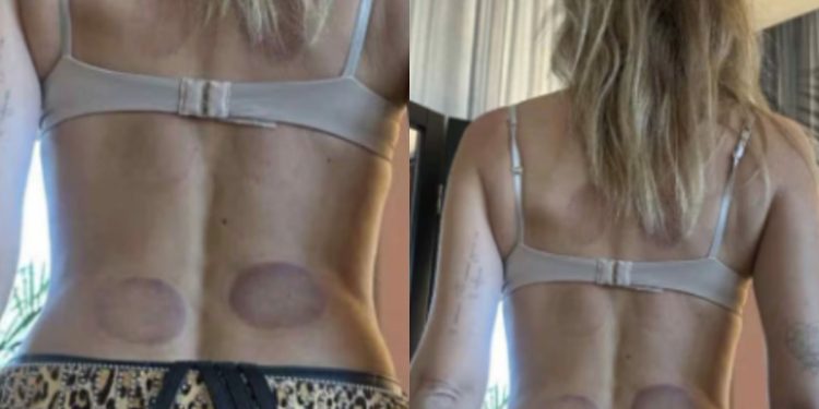 Cupping Therapy, Chiara Ferragni