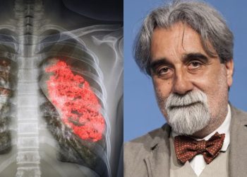 Polmonite interstiziale, Beppe Vessicchio