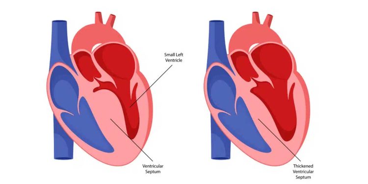 Malattia di Martina Nasoni